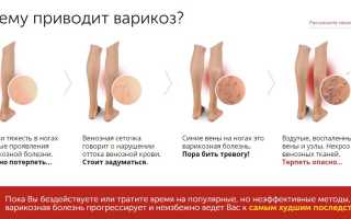 Кровотечение из варикозных вен нижних конечностей. причины, диагностика и лечение